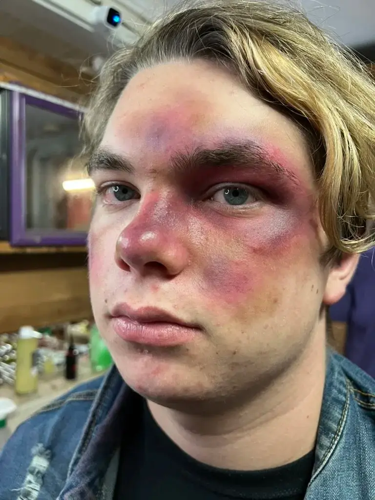 Swollen purple black eye and bruising across the nose