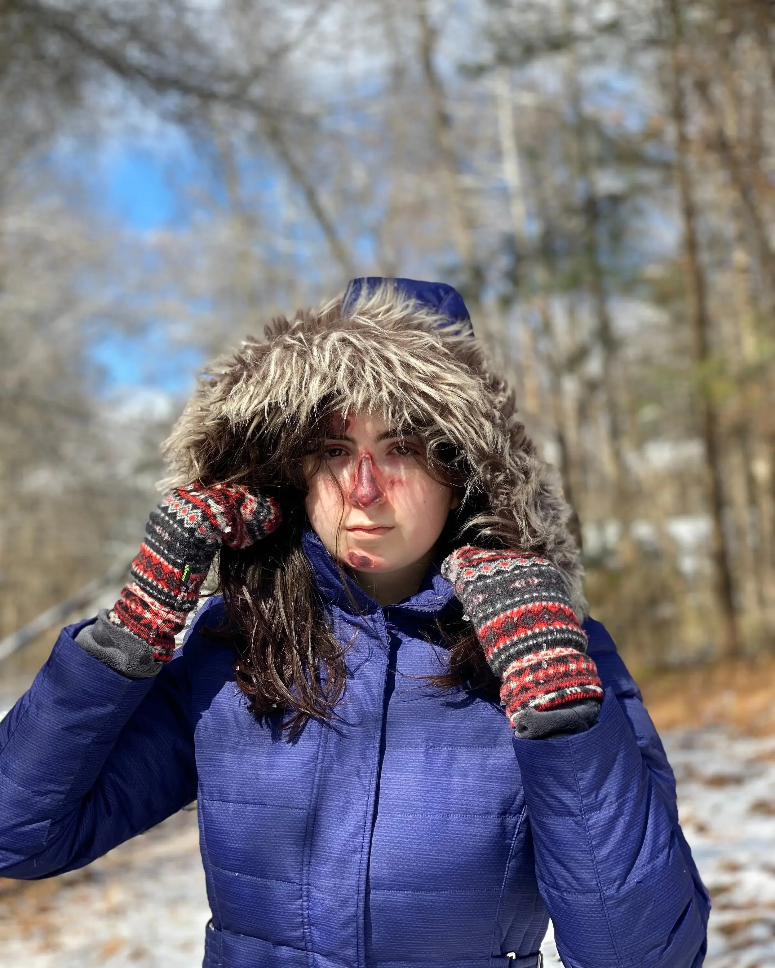 Frostbitten nose and cheeks on a woman in a fur-hooded parka in the snow