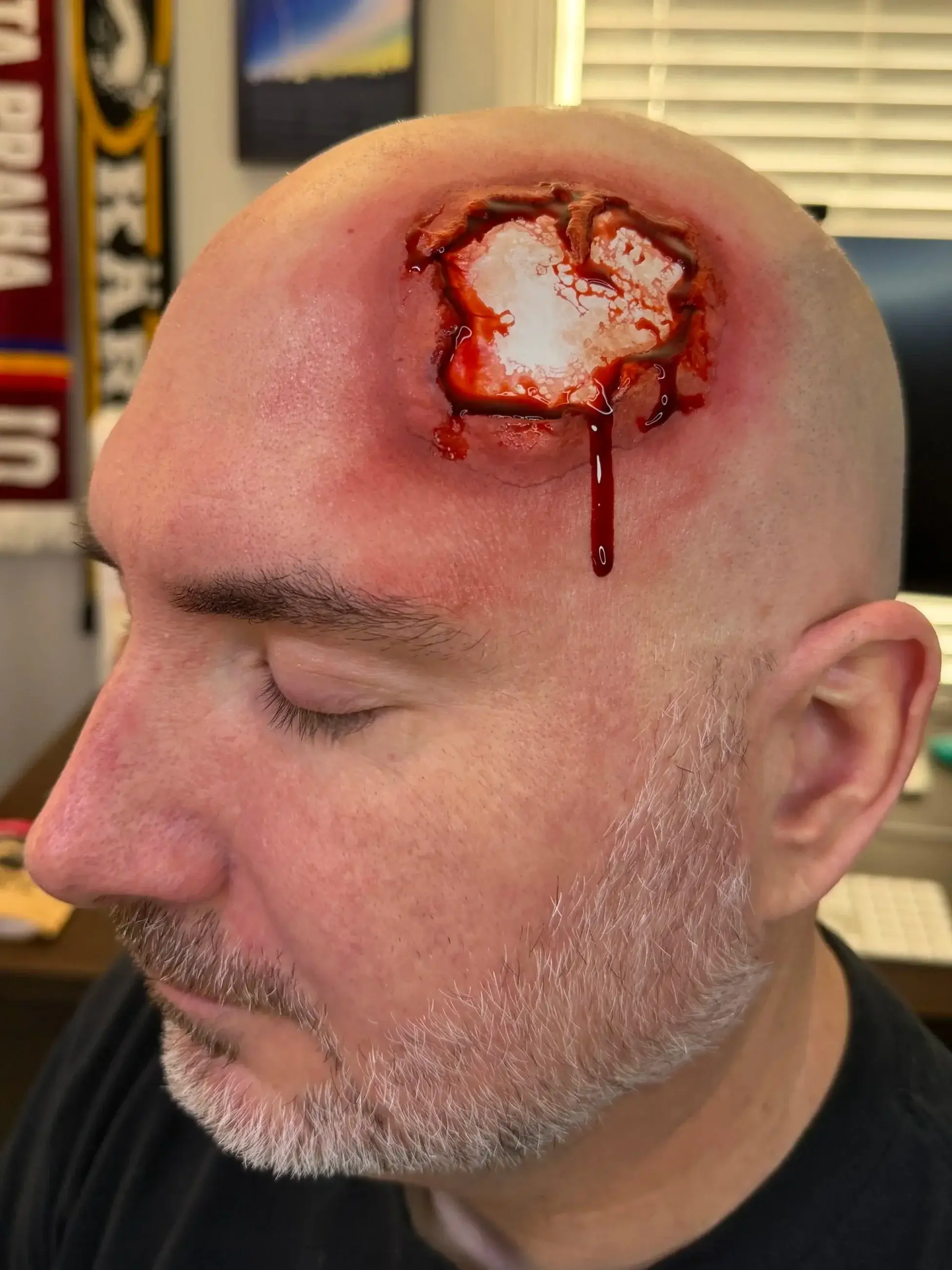 Open head wound on a bald scalp exposing bone, with blood running down the temple