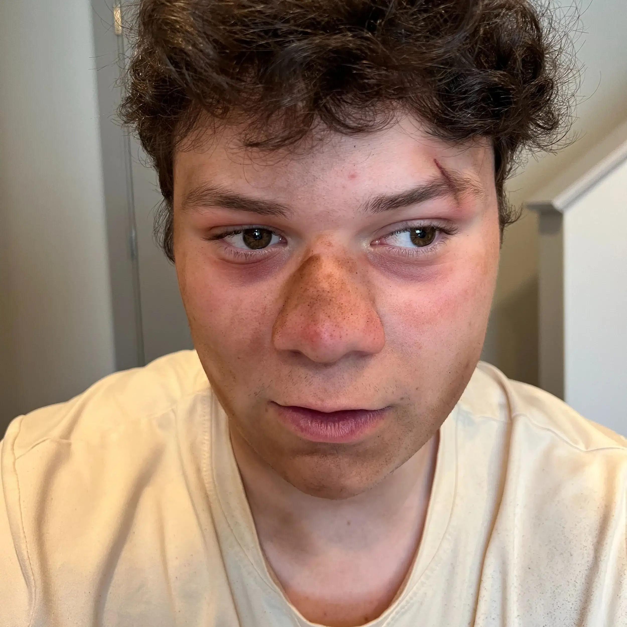 Swollen, reddened nose and flushed cheeks on a young man