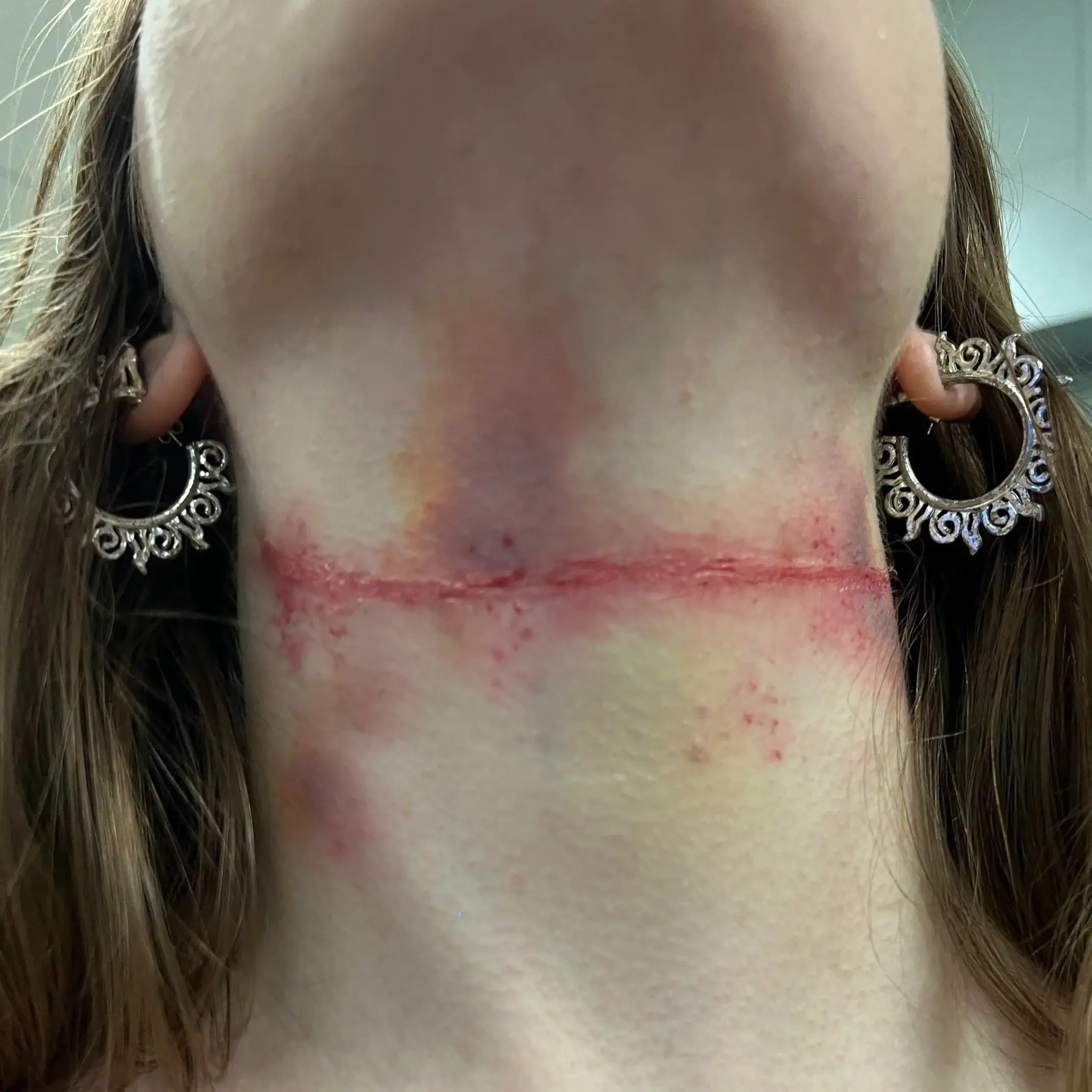 Red ligature scar circling the front of a throat